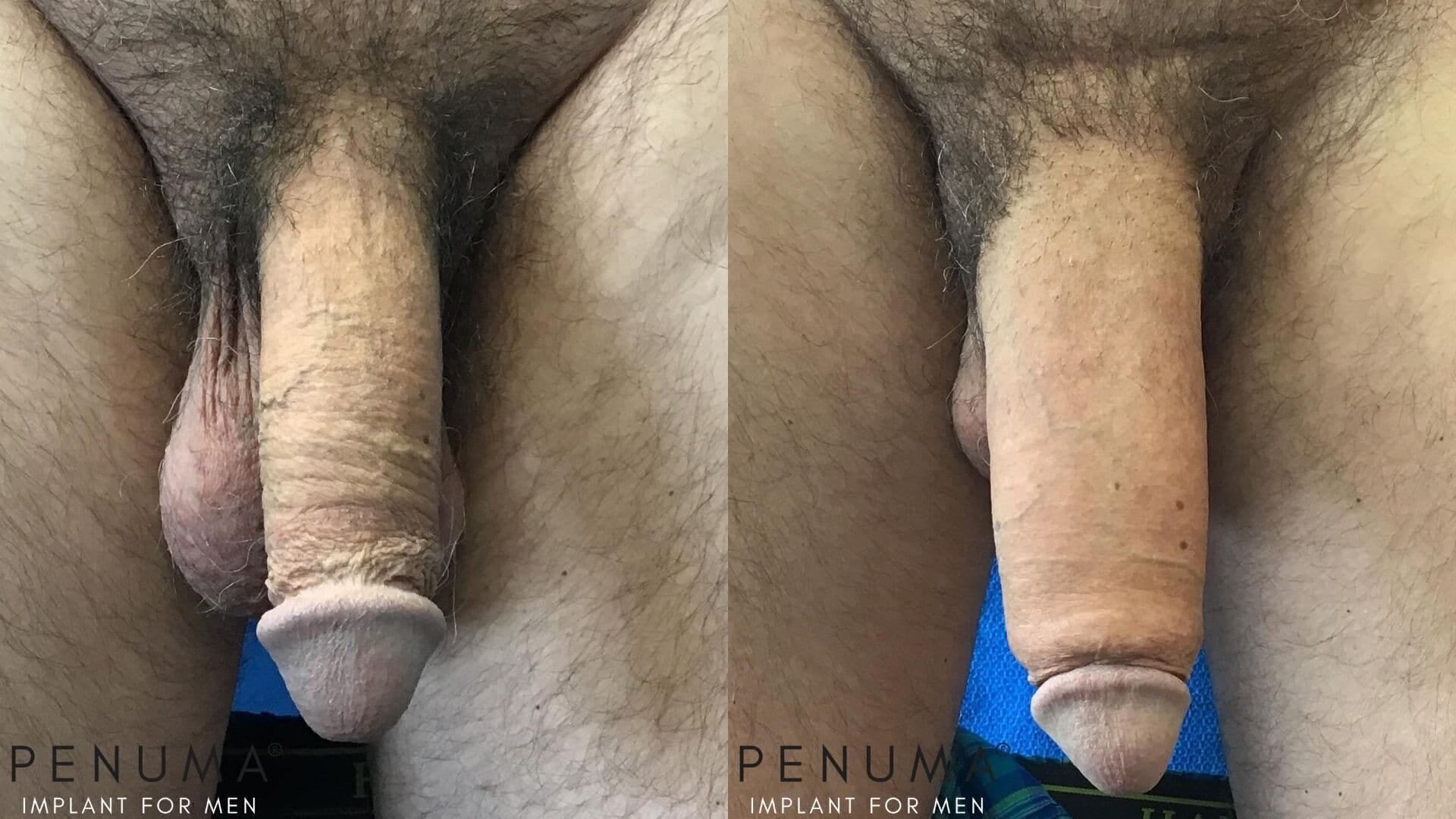 Penuma penile implant before and after