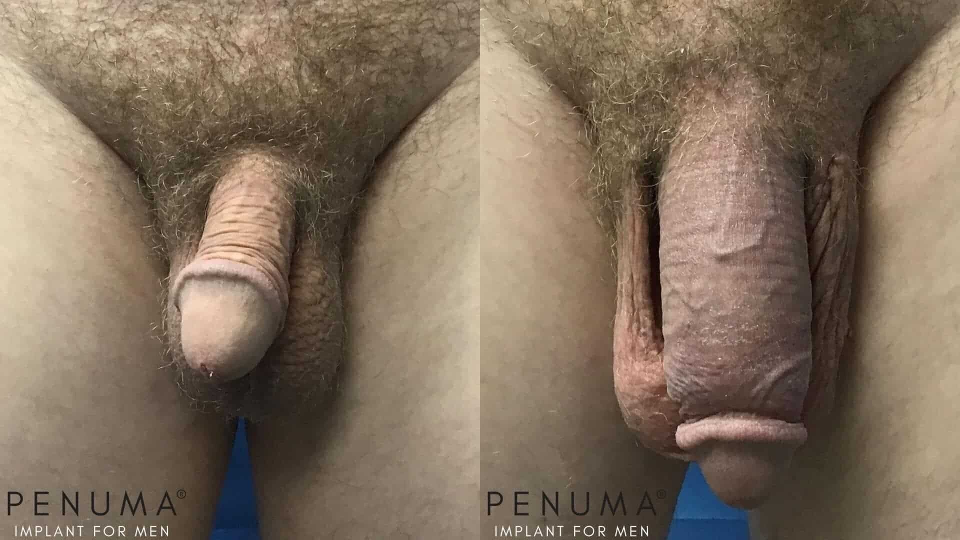 penis enlargement before and after pics