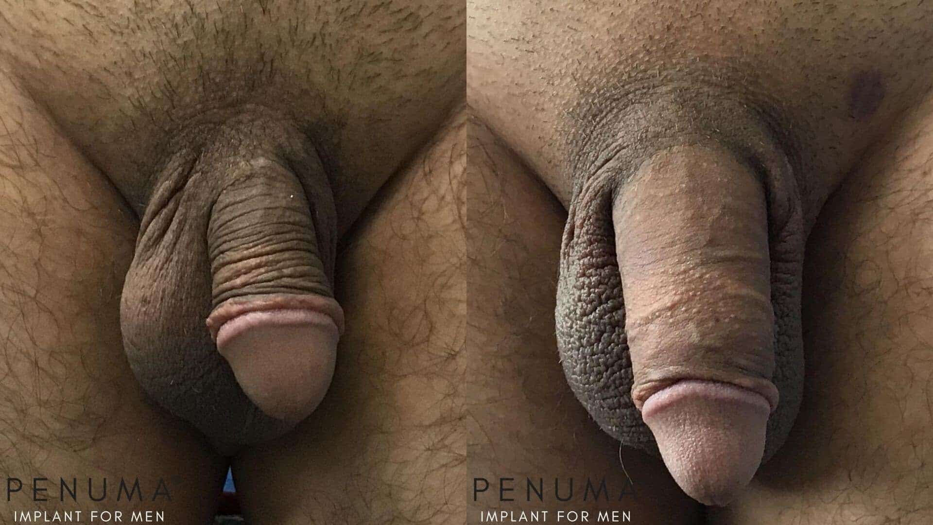 penis enlargement results before and after