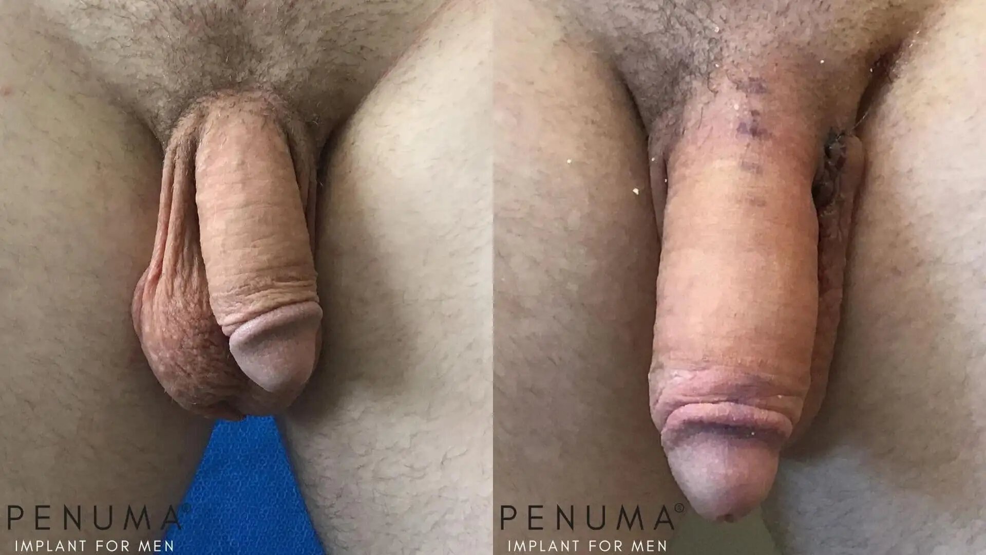 Ver foto de pênis