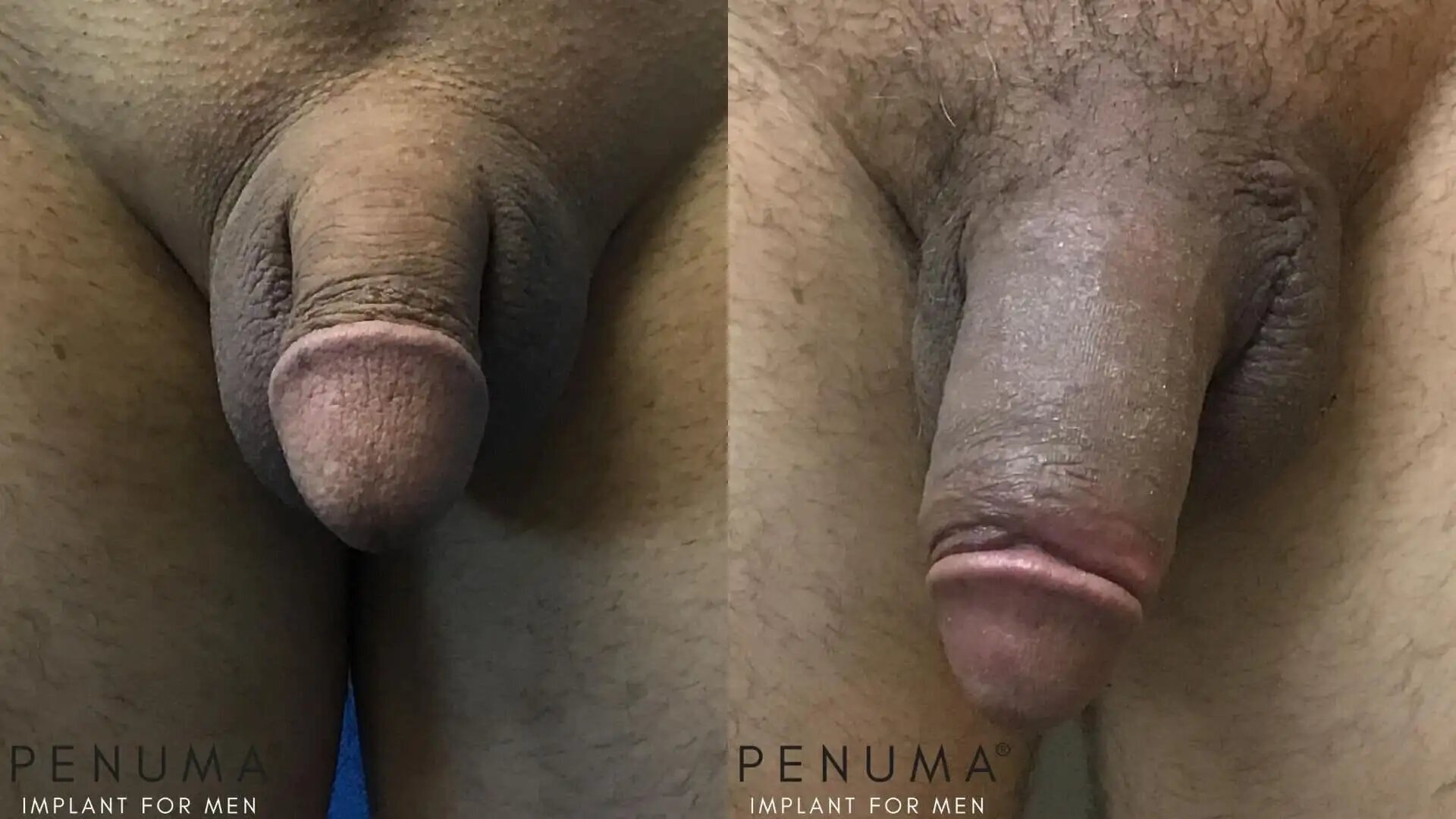 penuma-before-and-after14