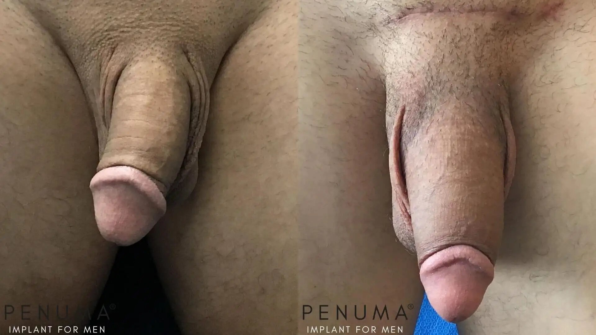 penuma-before-and-after15