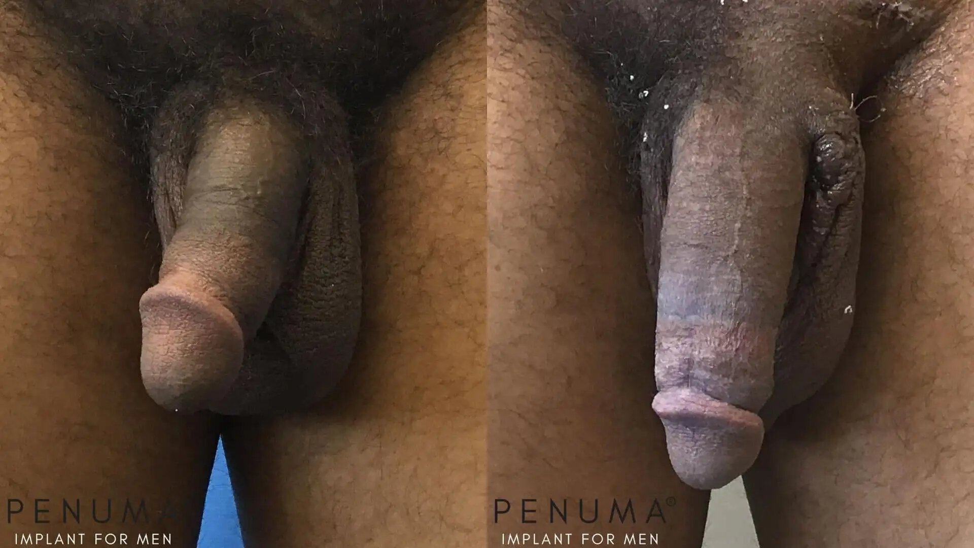 penuma-penile-enhancement7