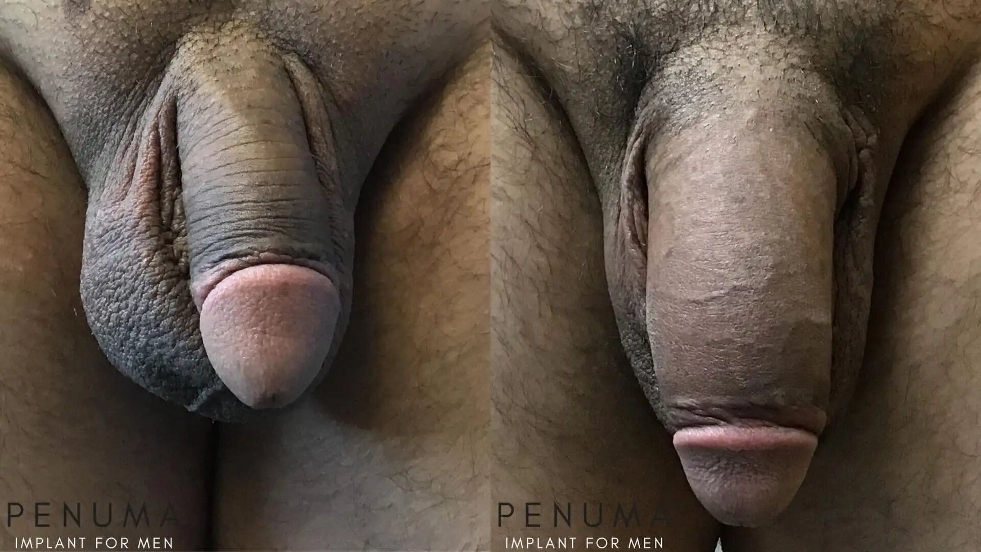 penuma-penis-enlargement2