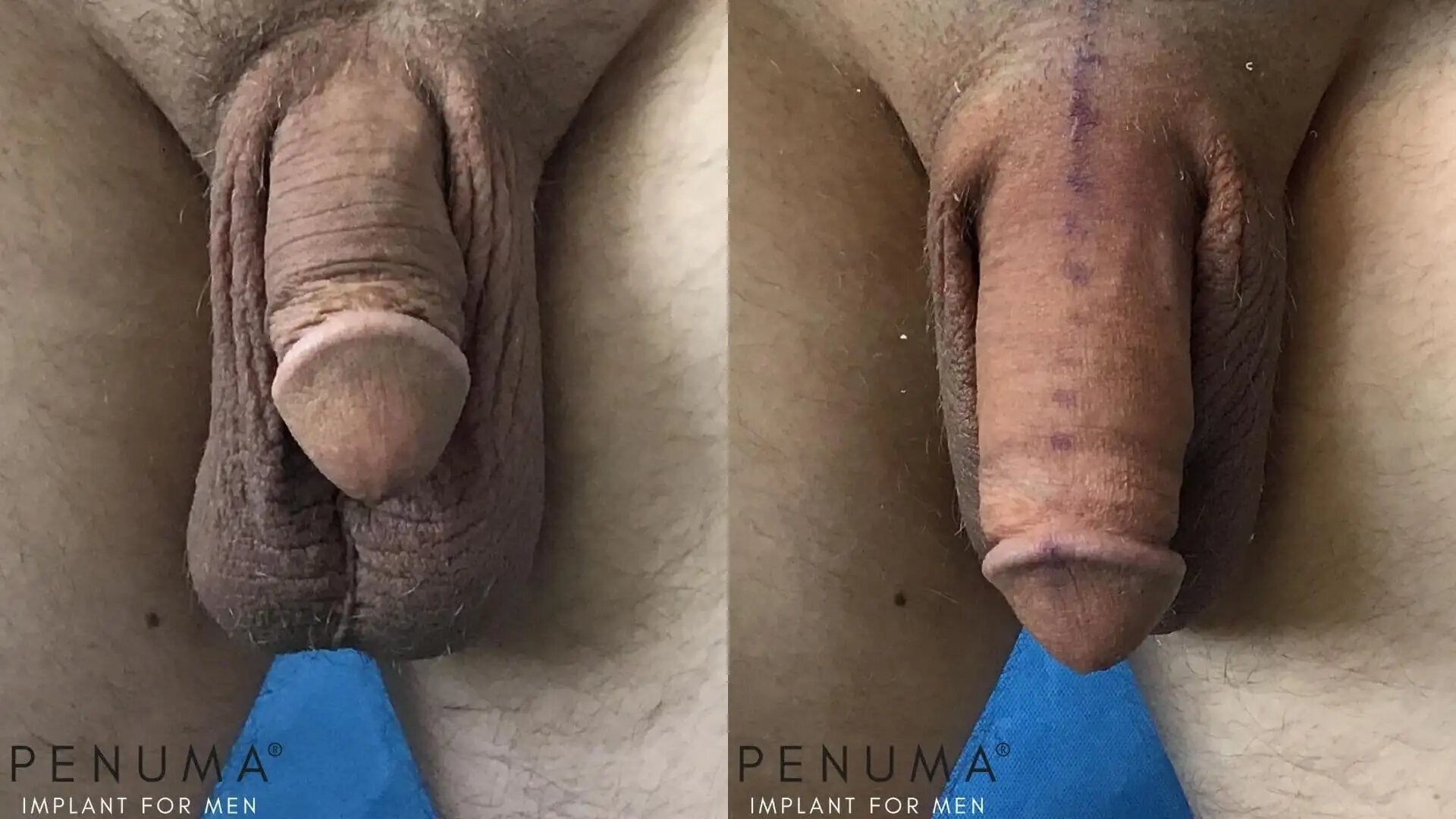 penuma-penis-enlargement3